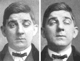 Ptosis Schlafzimmerblick Myasthenia_Gravis Ptosis Schlafzimmerblick Myasthenia_Gravis